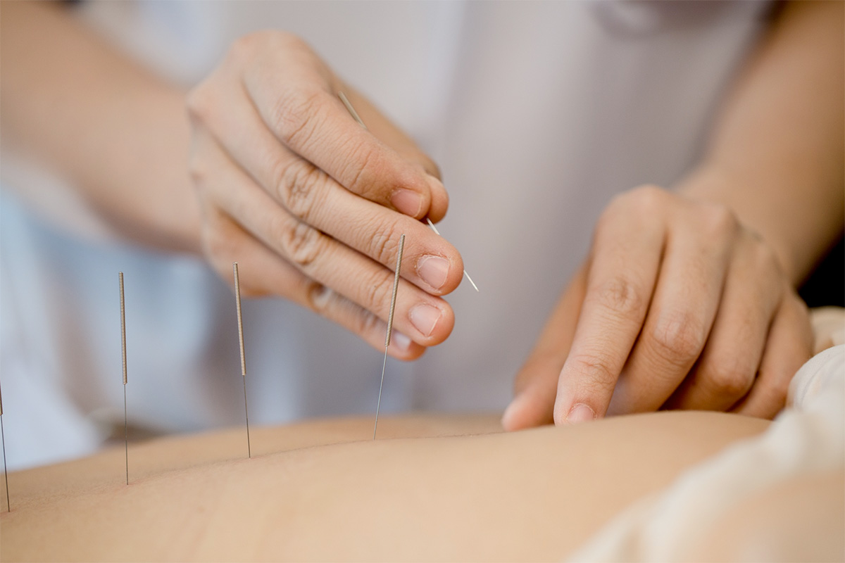Akupunktur 